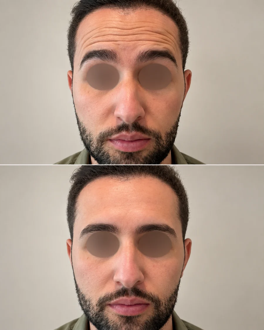 Registro de antes e depois de toxina botulínica na testa e glabela, paciente da Clínica Duvier